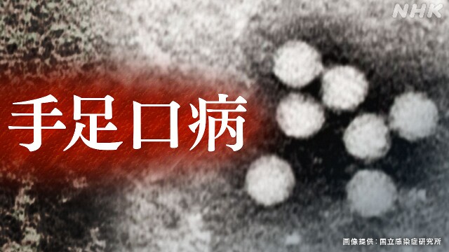 手足口病 過去10年同期比で最多に 国立感染研