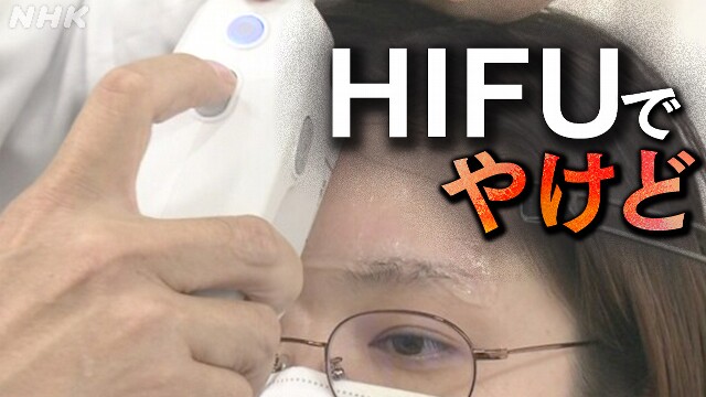 “HIFUでやけど”裁判始まる 医師免許なしの施術 違法性が焦点